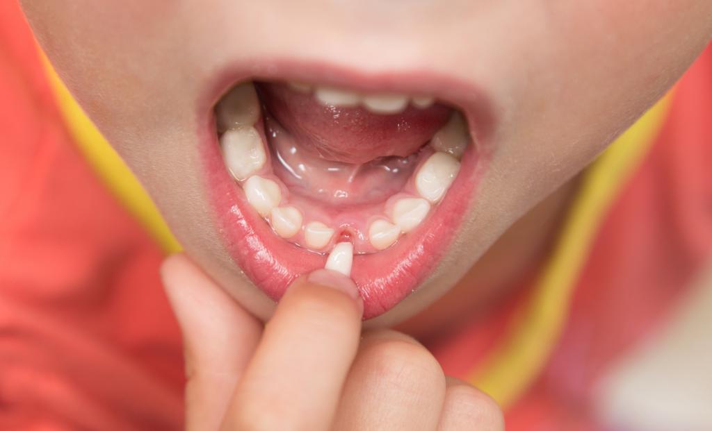 Что делать, если ребенку выбили передние зубы