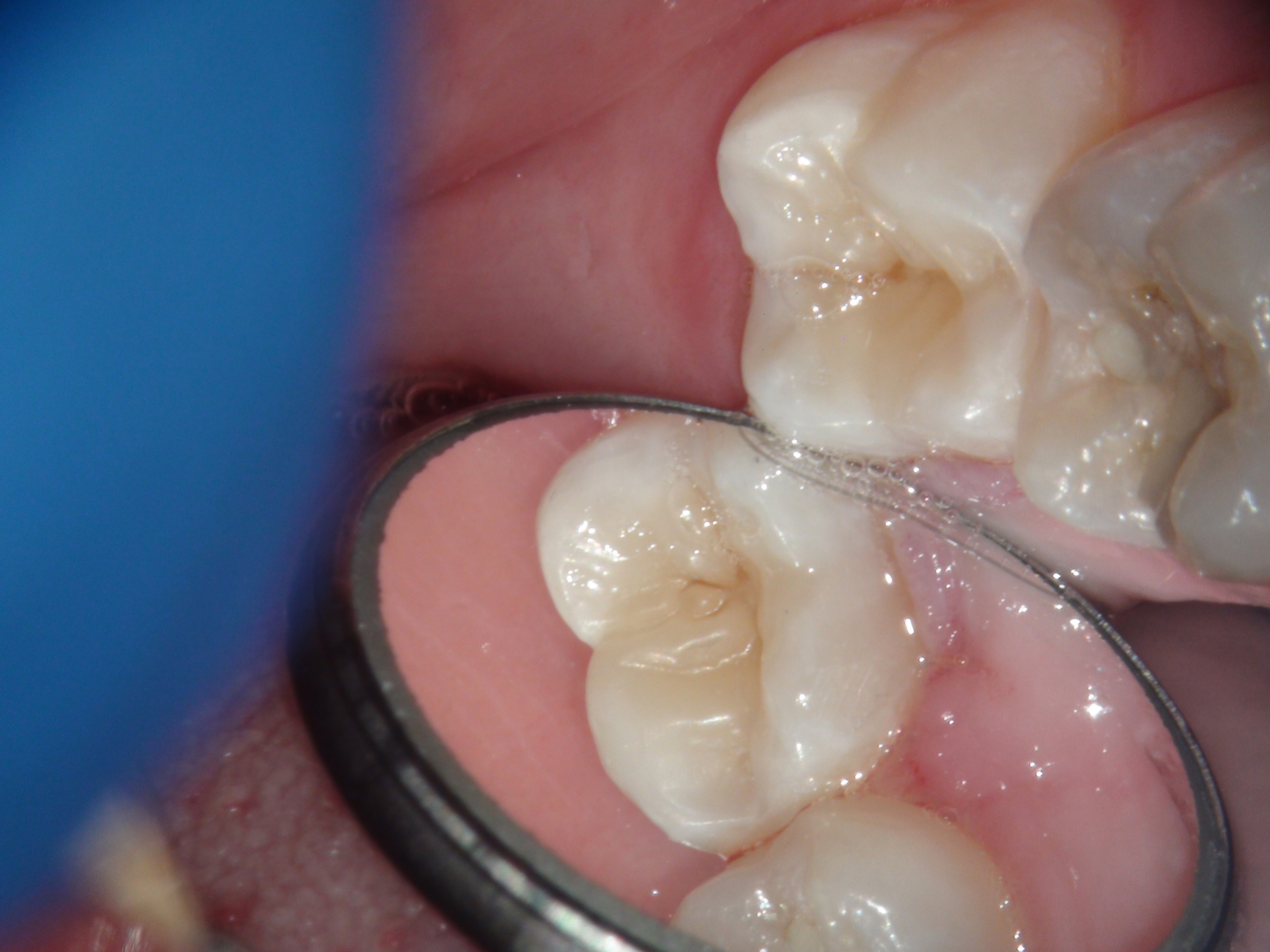 Лечение кариеса 37 зуба