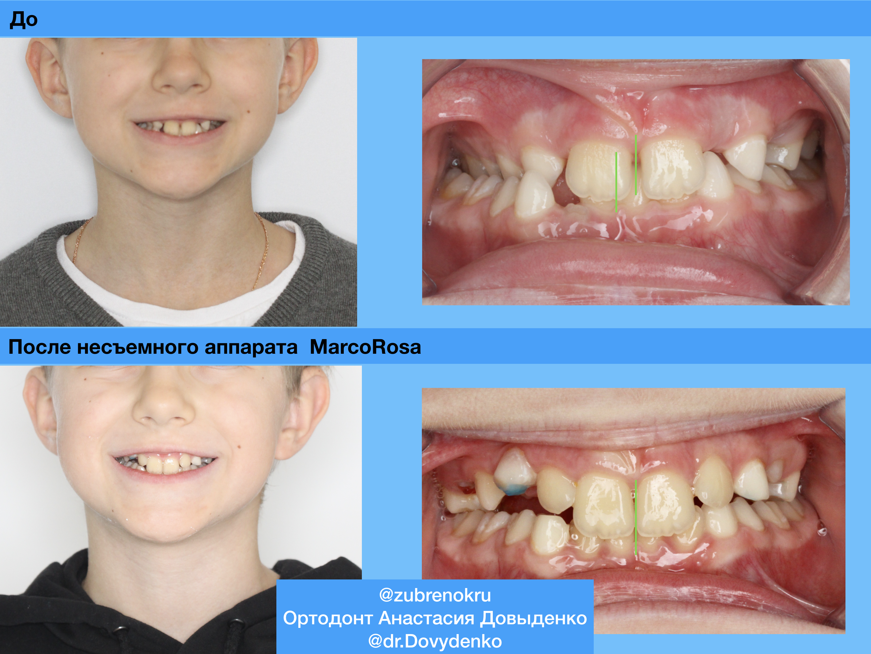 Ортодонтическое лечение на аппарате Marco Rossa