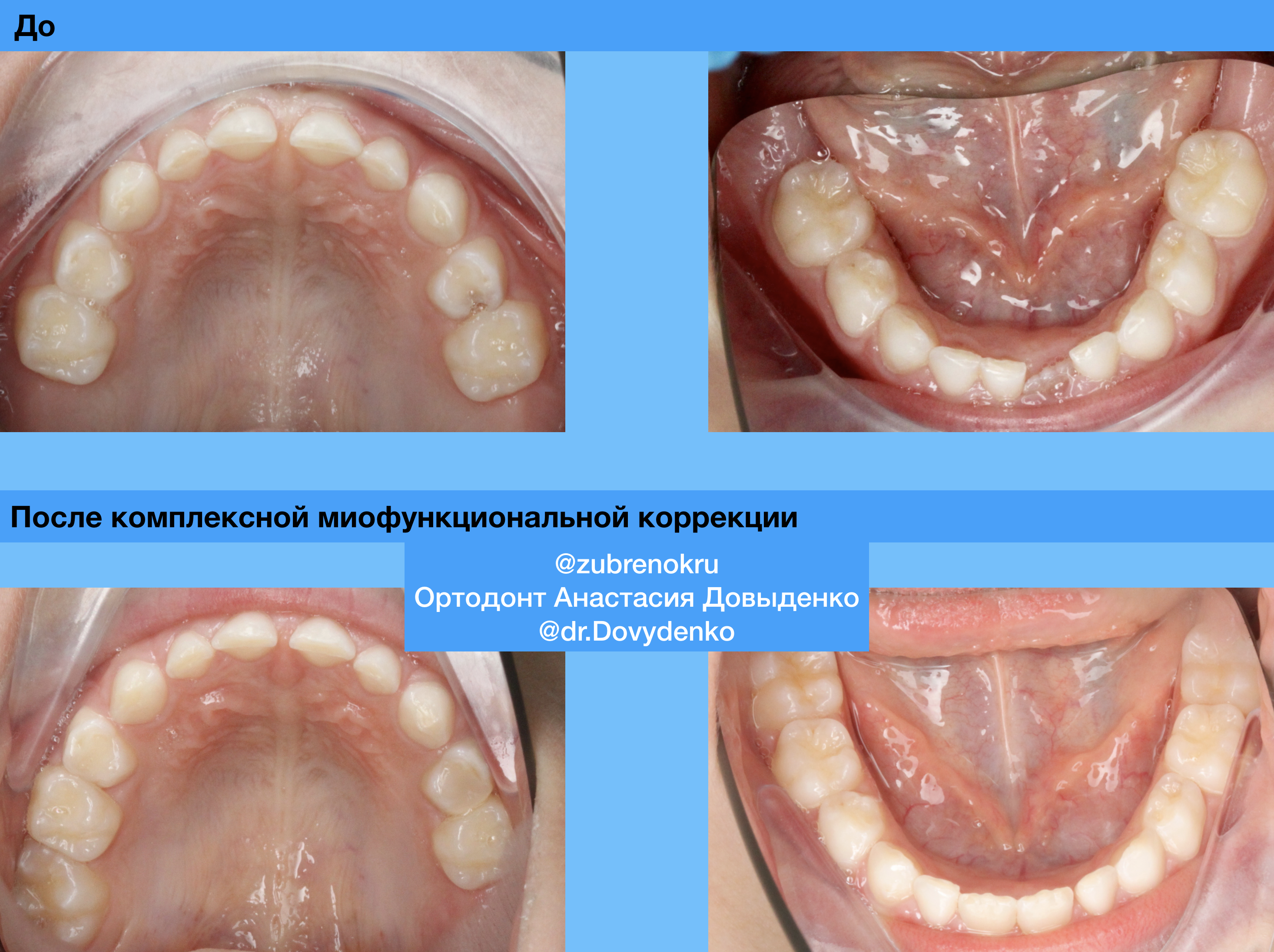 Ортодонтическое лечение с использованием силиконовой каппы Myobrace