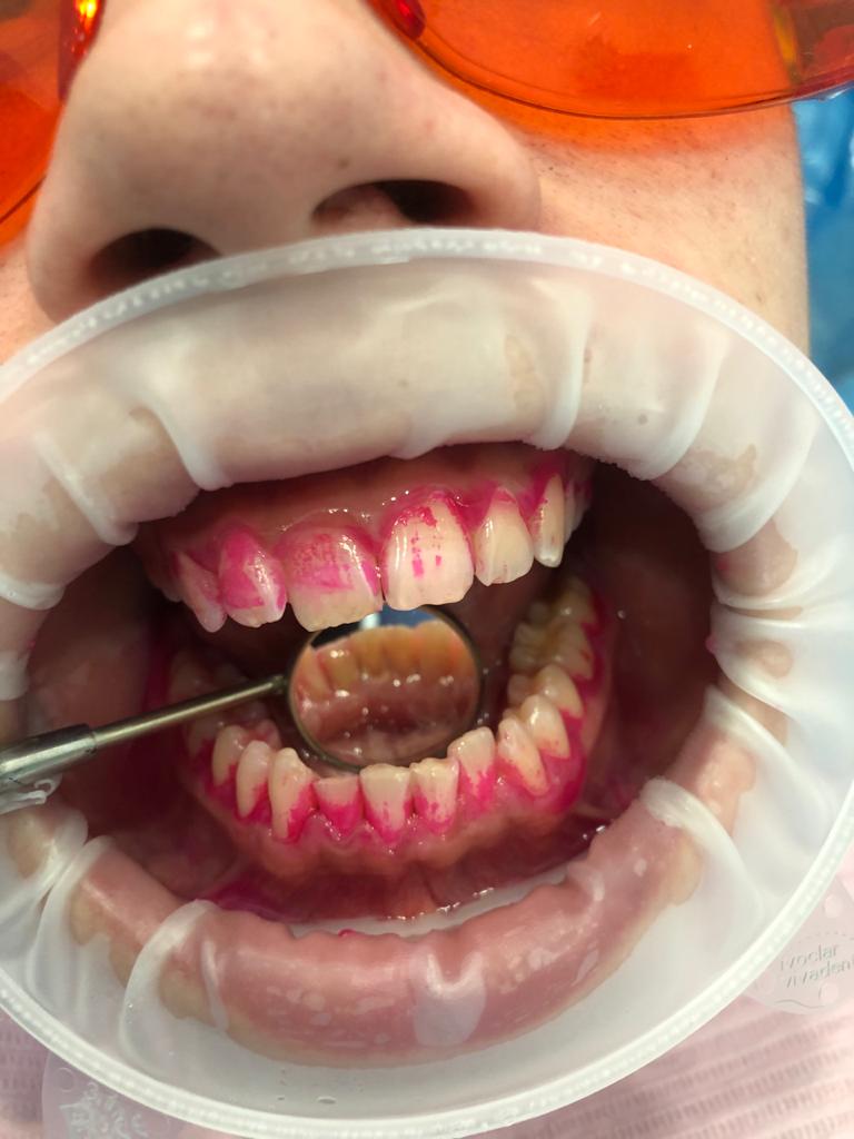 Гигиена и профилактика зубов