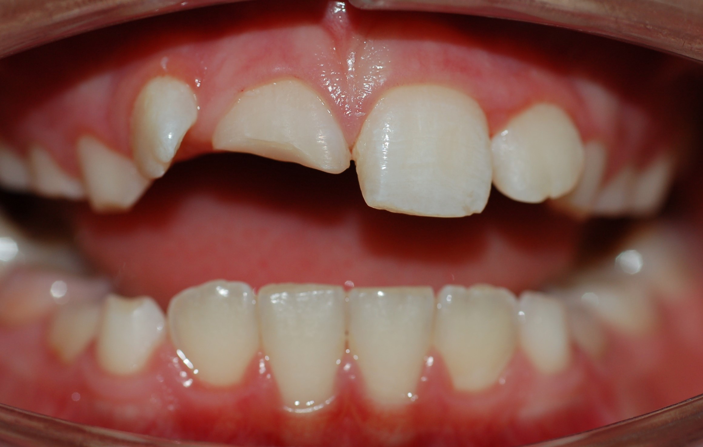 Реставрация зубов после травмы 11 зуба