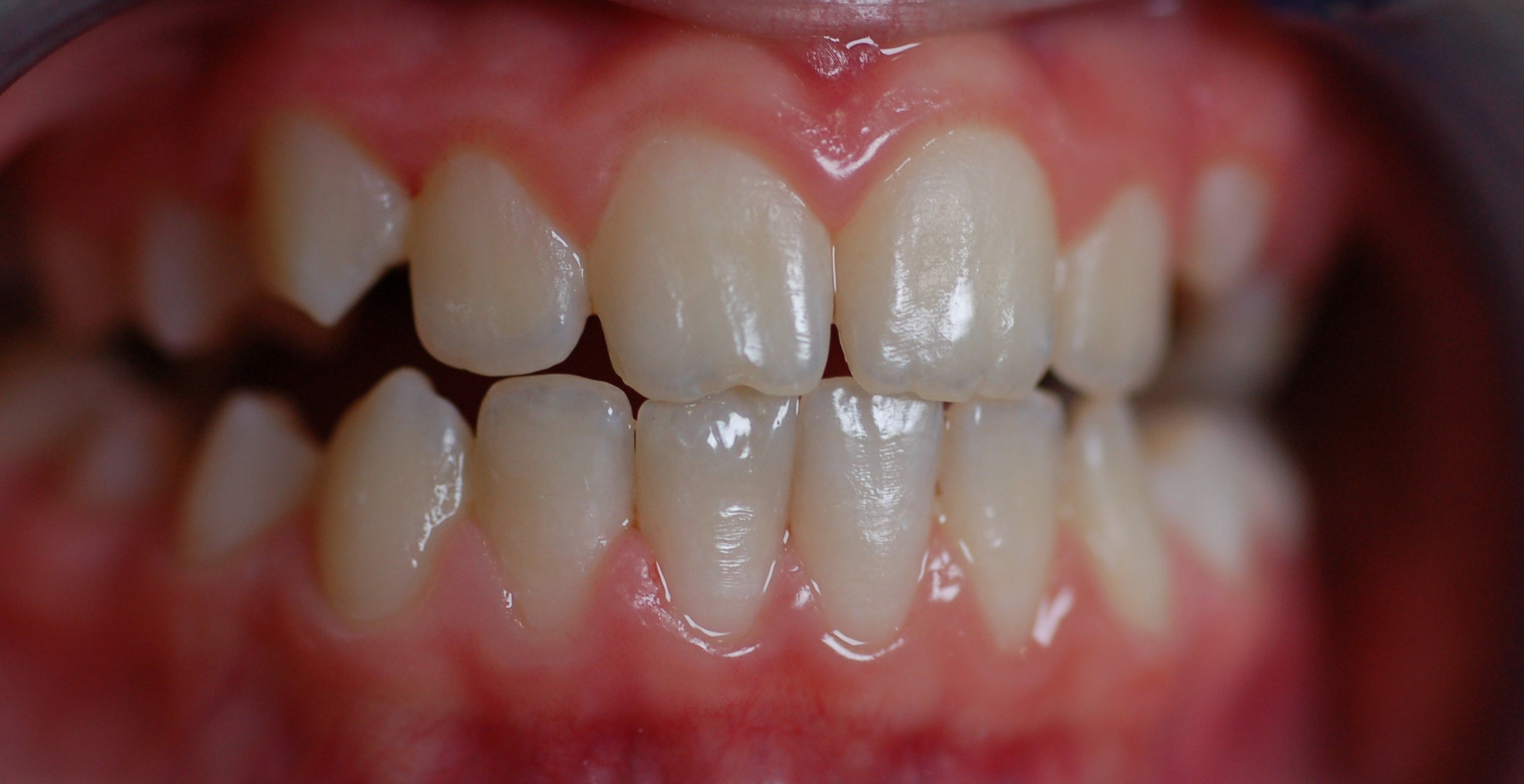 Реставрация осложненной травмы зуба