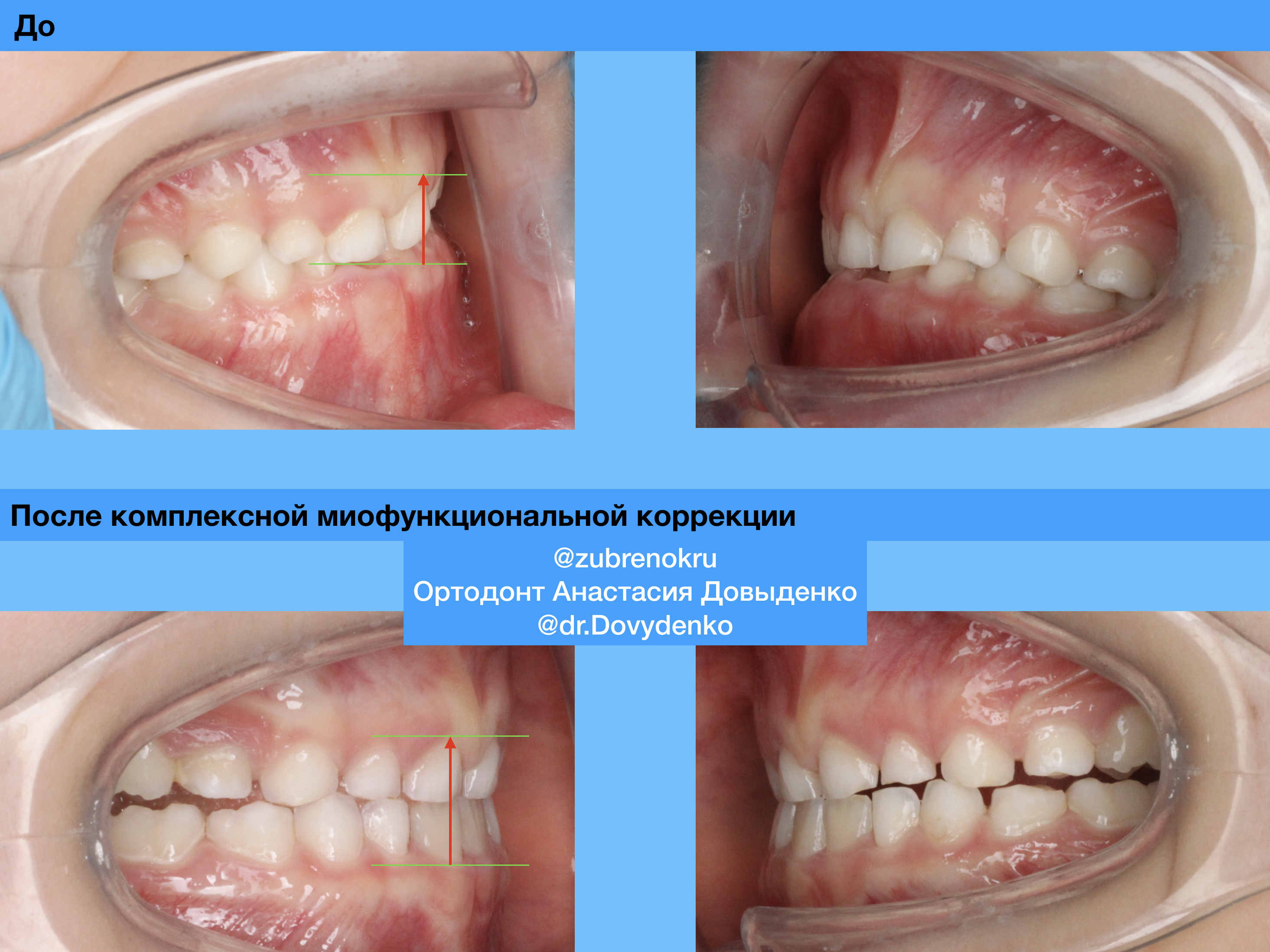 Ортодонтическое лечение с использованием силиконовой каппы Myobrace