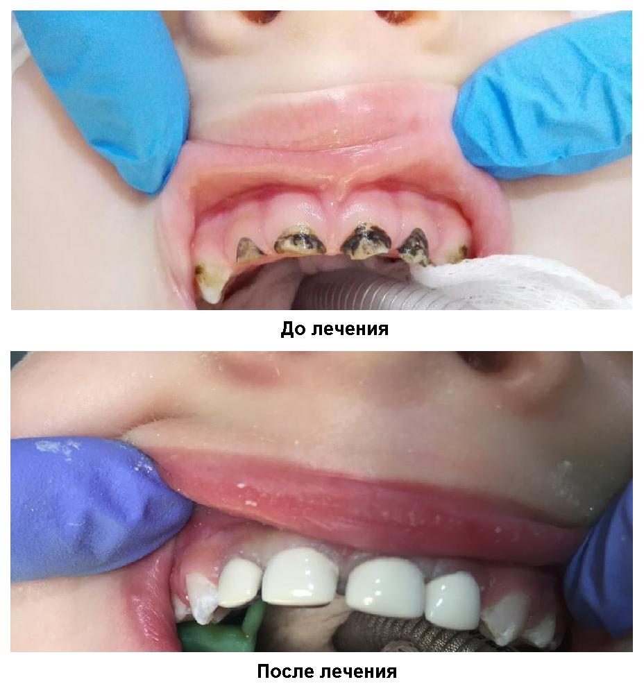 Анестезия детям при лечении зубов томск стоматология цены