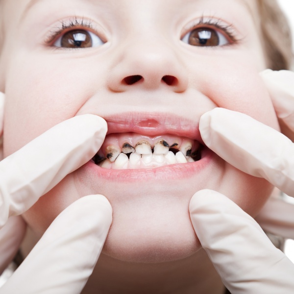 Роль хеликобактер пилори в развитии кариеса зубов у детей