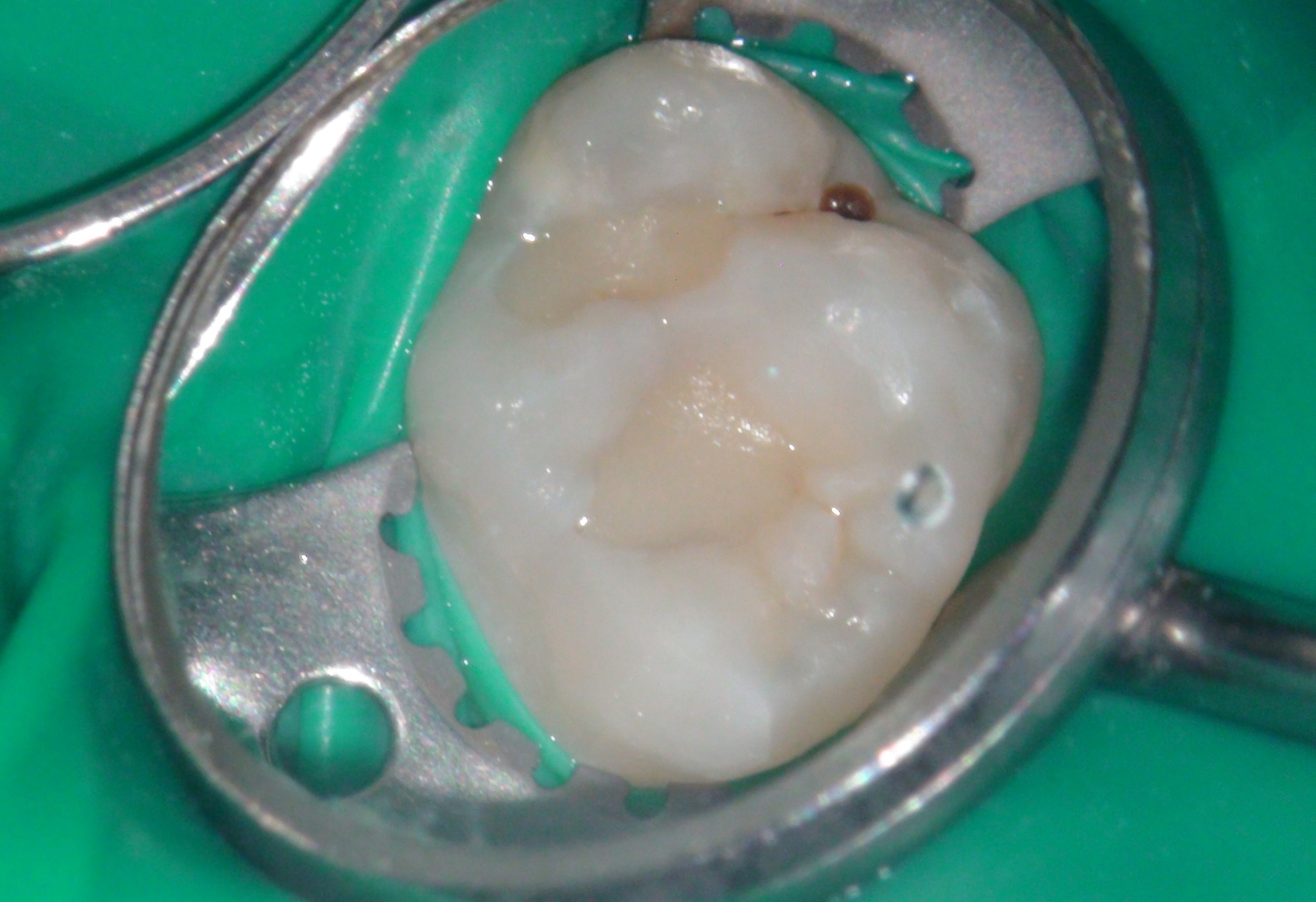 Лечение кариеса 16 зуба