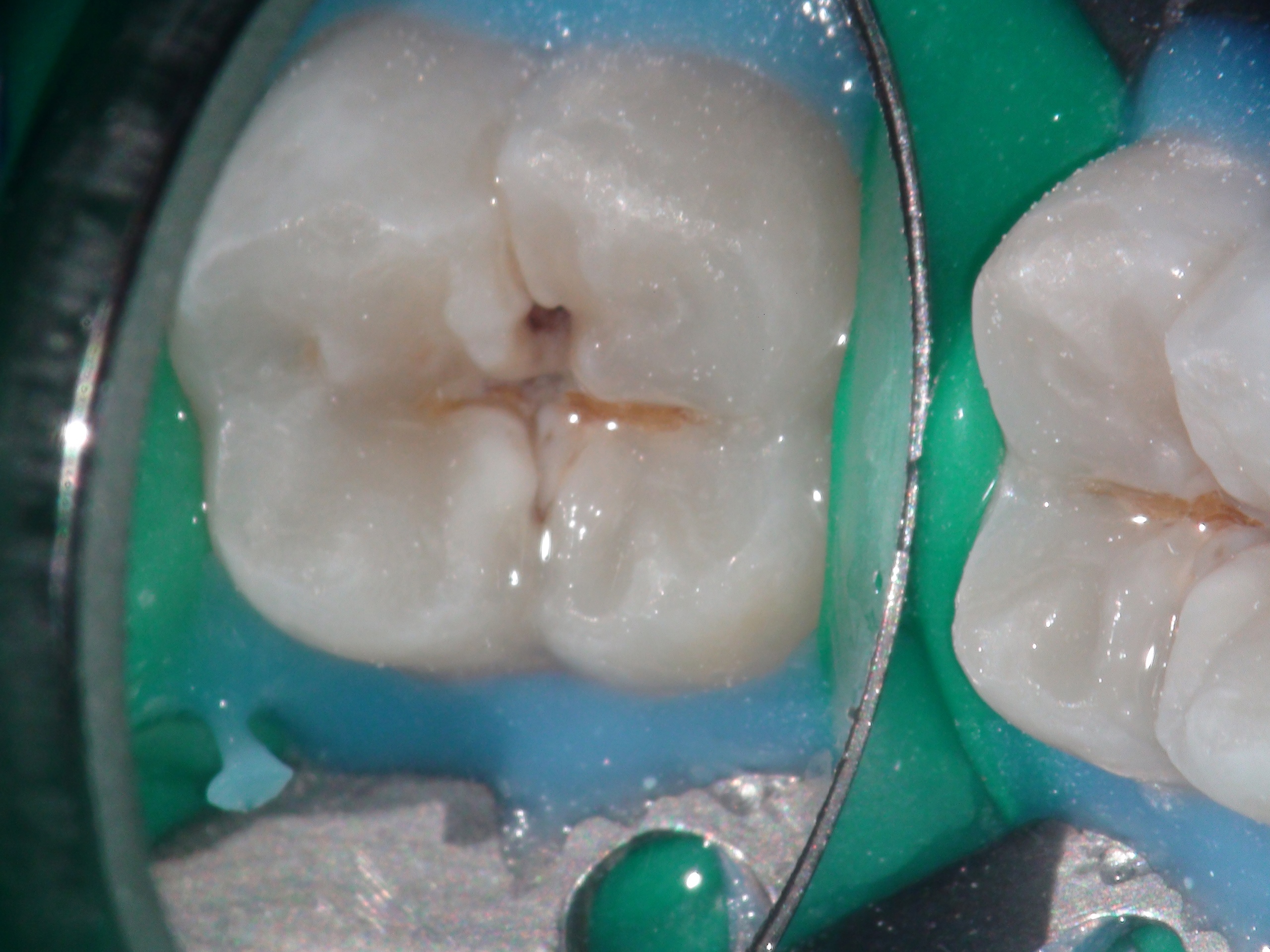 Лечение кариеса 37 зуба