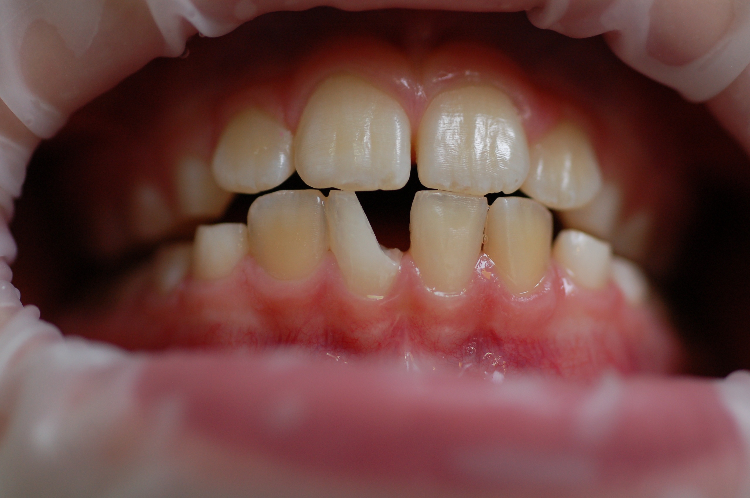 Реставрация зубов после травмы 41 зуба