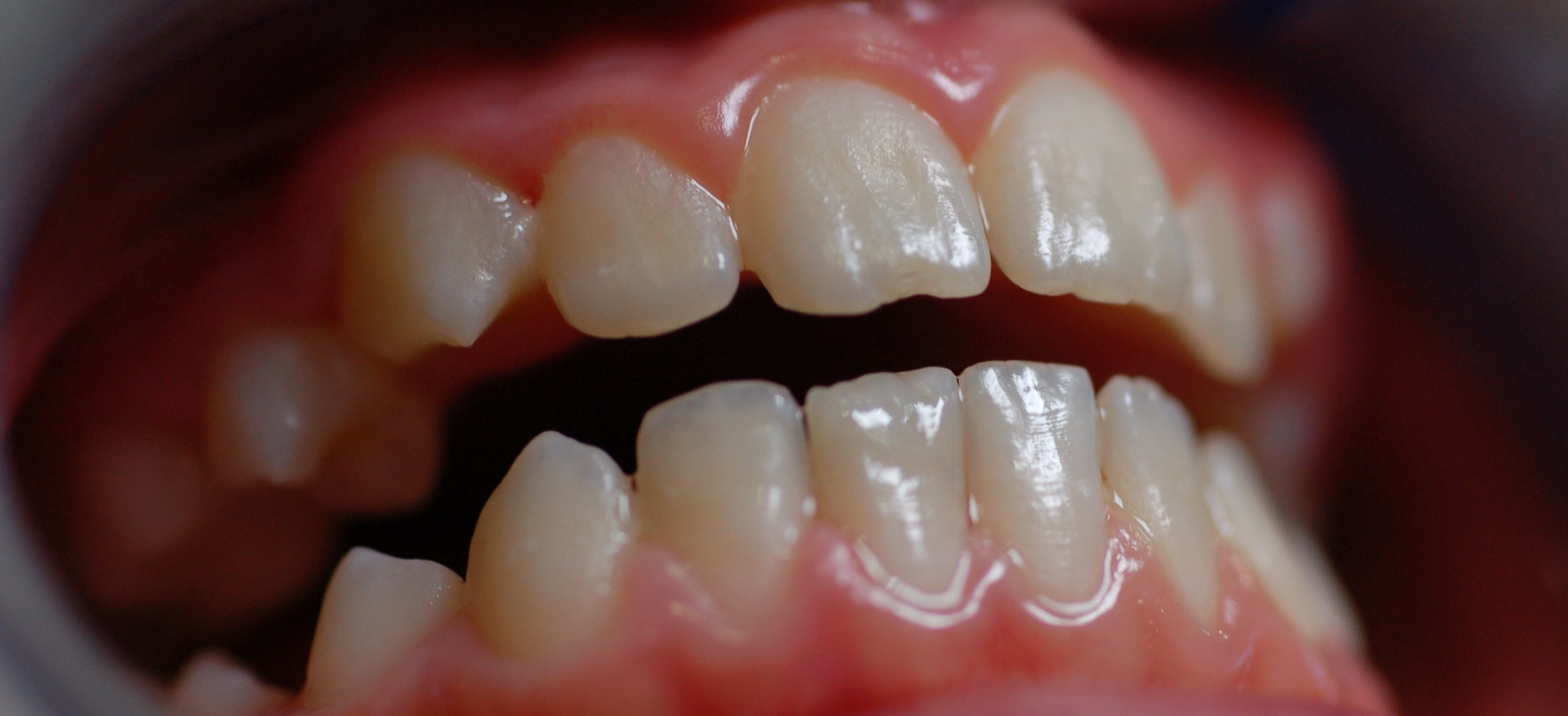 Реставрация осложненной травмы зуба