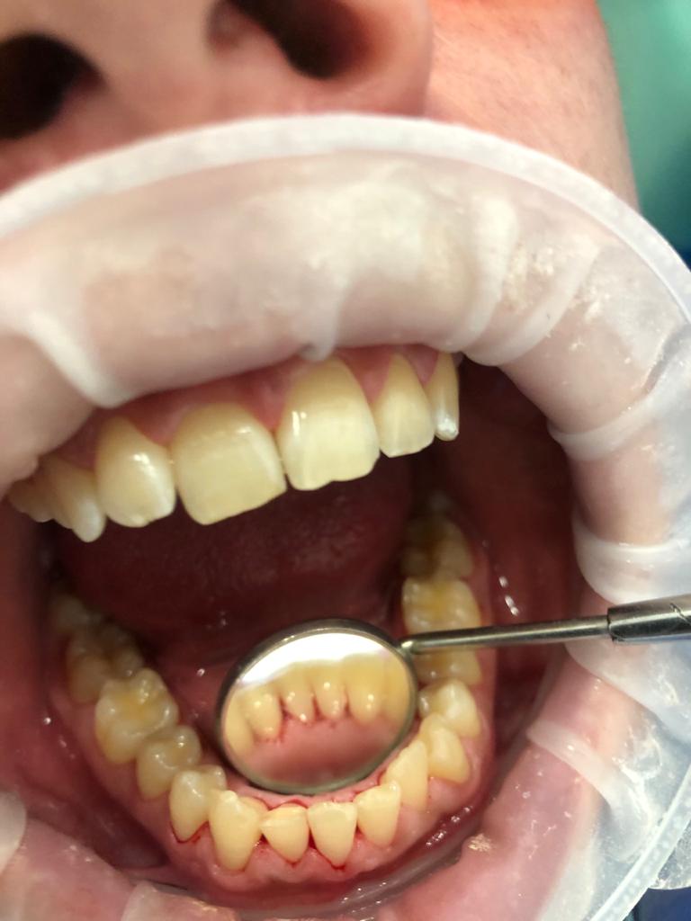 Гигиена и профилактика зубов с чисткой
