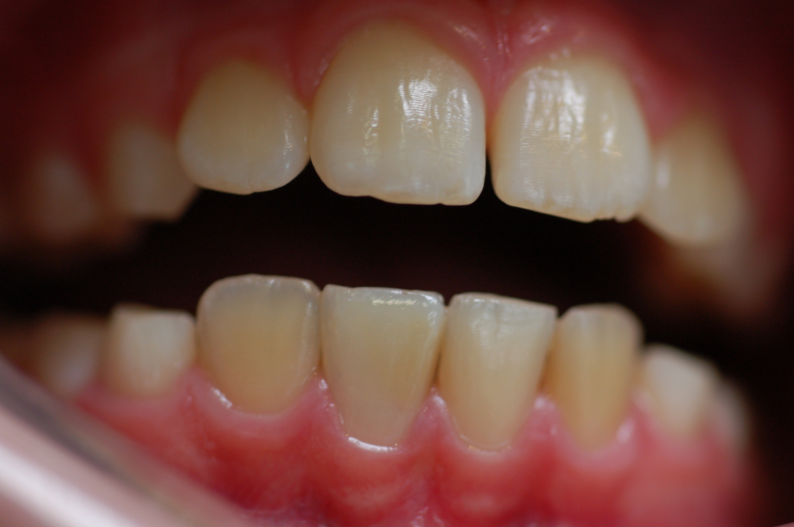 Реставрация зубов после травмы 41 зуба