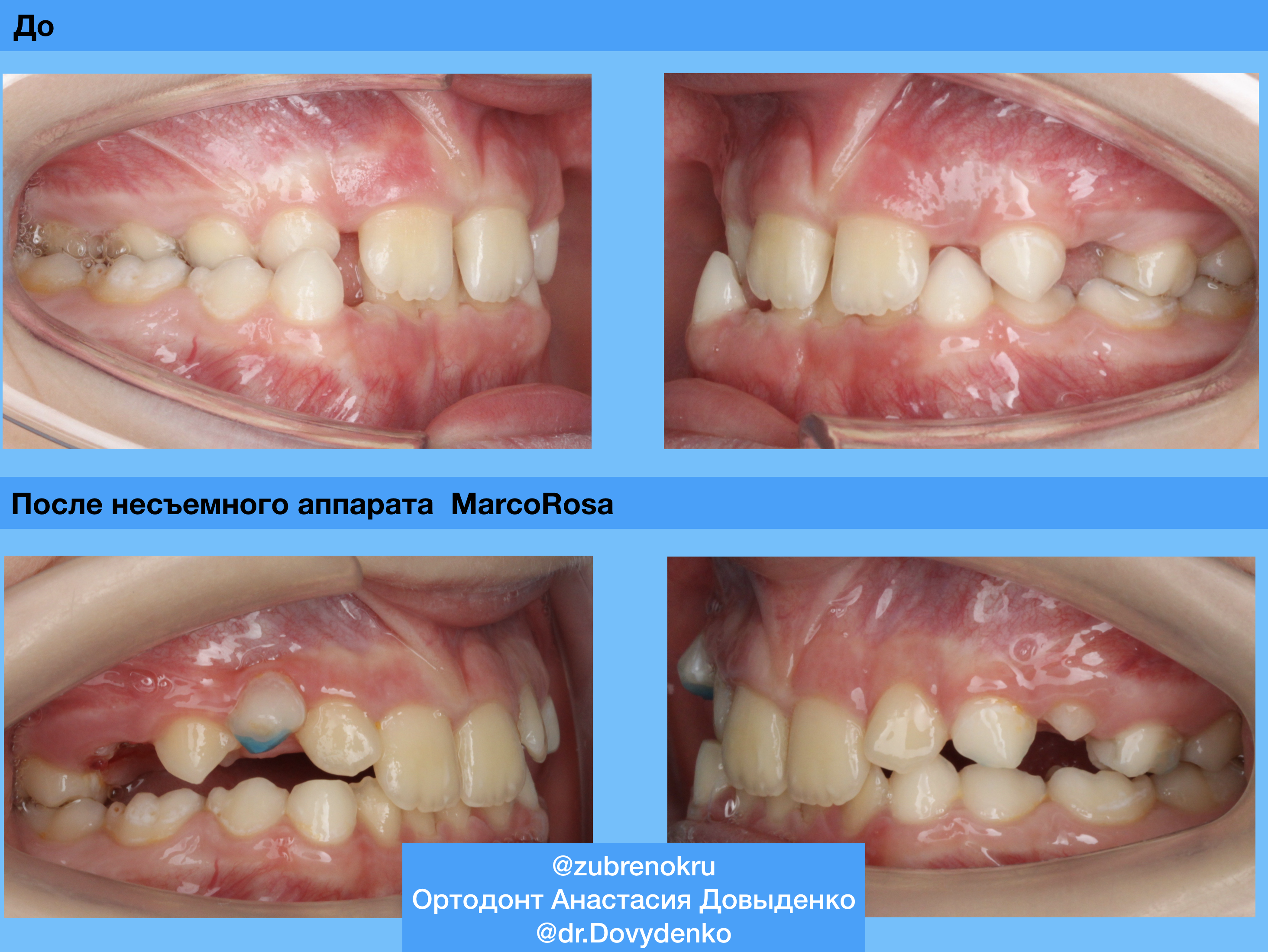 Ортодонтическое лечение на аппарате Marco Rossa