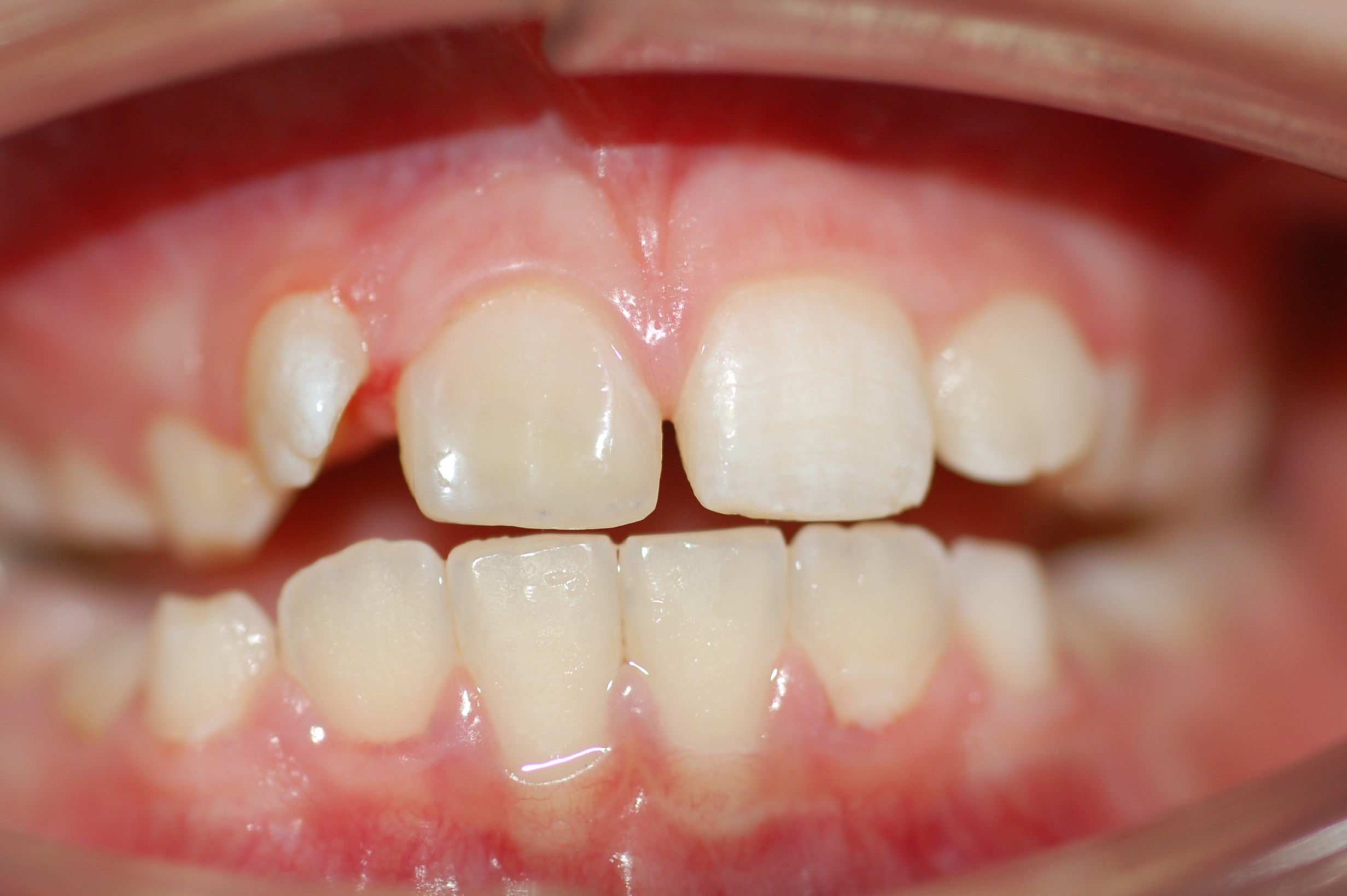 Реставрация зубов после травмы 11 зуба